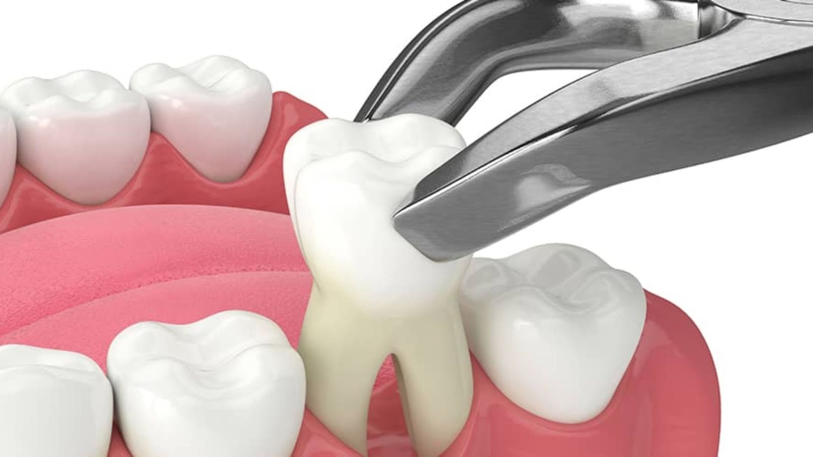 Dry Socket After Molar Extraction